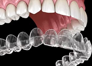 Clear Aligner Therapy (CAT)